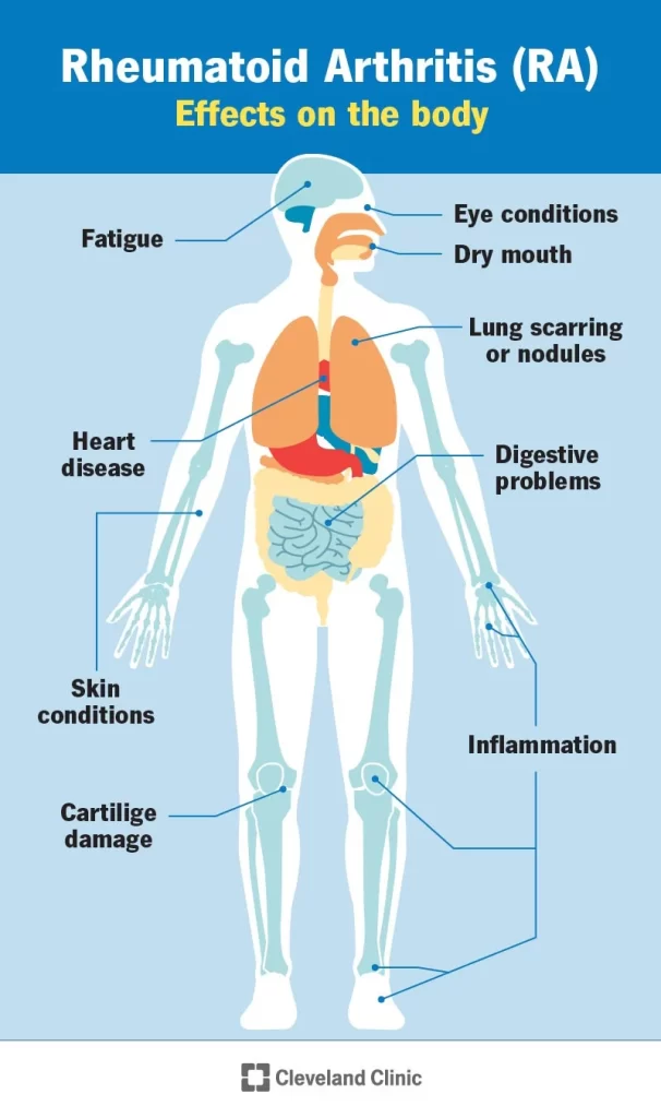 Rheumatoid Arthritis